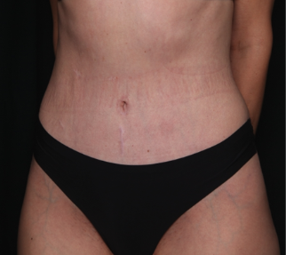 Tummy Tuck Before & After Patient #34604