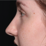 Rhinoplasty Before & After Patient #34592