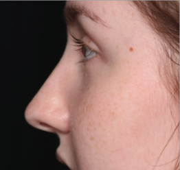 Rhinoplasty Before & After Patient #34592