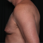 Gynecomastia Before & After Patient #34603