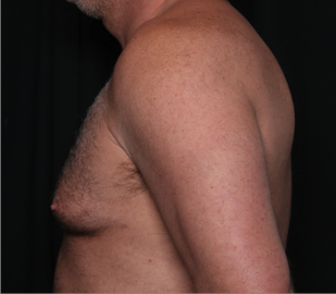 Gynecomastia Before & After Patient #34603