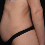 Tummy Tuck Before & After Patient #34604