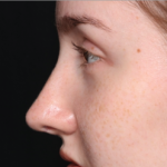 Rhinoplasty Before & After Patient #34592