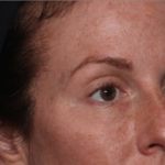 Injectable Fillers Before & After Patient #34602