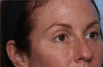 Injectable Fillers Before & After Patient #34602