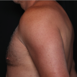 Gynecomastia Before & After Patient #34603