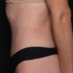 Tummy Tuck Before & After Patient #34604