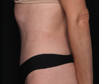 Tummy Tuck Before & After Patient #34604