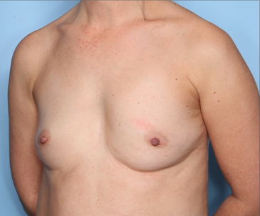 Breast Augmentation Before & After Patient #34601