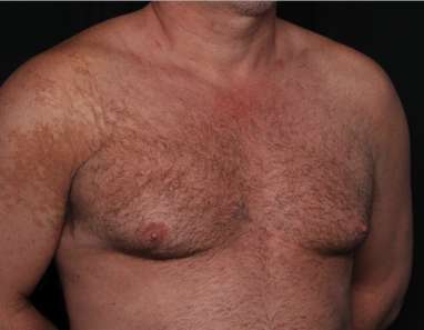 Gynecomastia Before & After Patient #34603