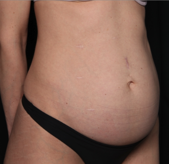 Tummy Tuck Before & After Patient #34604