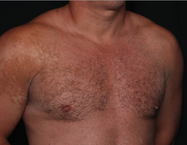 Gynecomastia Before & After Patient #34603