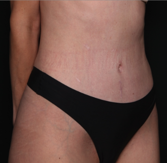 Tummy Tuck Before & After Patient #34604