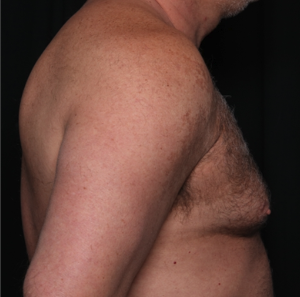 Gynecomastia Before & After Patient #34603