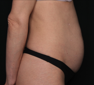 Tummy Tuck Before & After Patient #34604