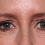 Blepharoplasty Before & After Patient #34649