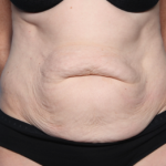 Tummy Tuck Before & After Patient #34668