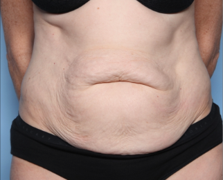 Tummy Tuck Before & After Patient #34668