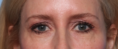 Blepharoplasty Before & After Patient #34649