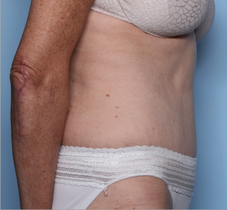 Tummy Tuck Before & After Patient #34668