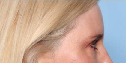 Blepharoplasty Before & After Patient #34649