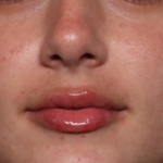 Lip Filler Before & After Patient #34661