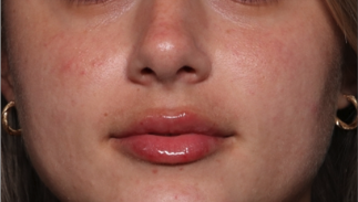 Lip Filler Before & After Patient #34661