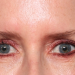 Blepharoplasty Before & After Patient #34649