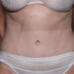 Tummy Tuck Before & After Patient #34668