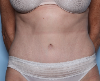 Tummy Tuck Before & After Patient #34668