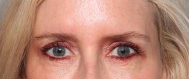 Blepharoplasty Before & After Patient #34649