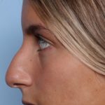 Rhinoplasty Before & After Patient #34690