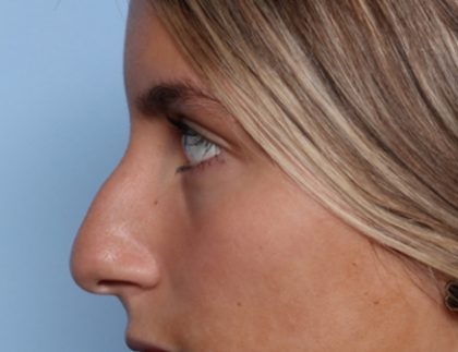 Rhinoplasty Before & After Patient #34690