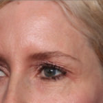 Blepharoplasty Before & After Patient #34649