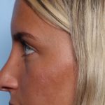 Rhinoplasty Before & After Patient #34690