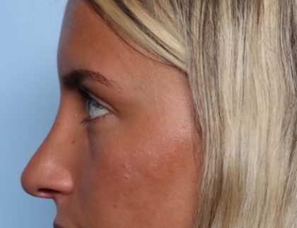 Rhinoplasty Before & After Patient #34690