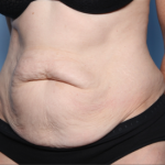 Tummy Tuck Before & After Patient #34668