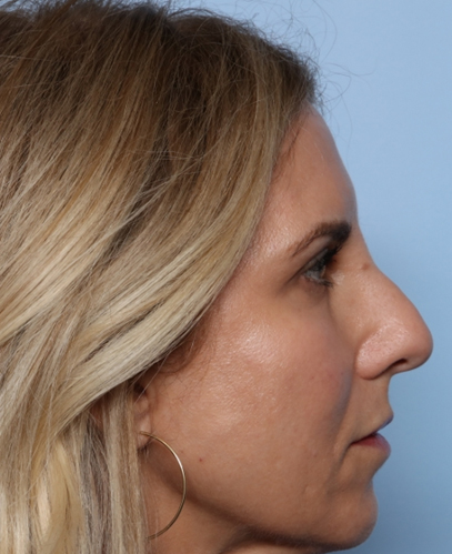 Injectable Fillers Before & After Patient #34707