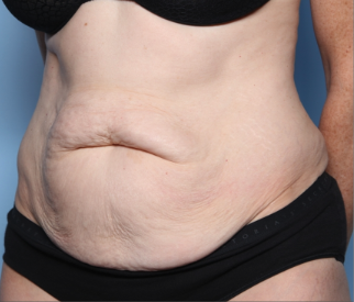 Tummy Tuck Before & After Patient #34668