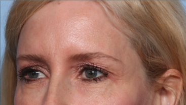 Blepharoplasty Before & After Patient #34649