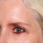 Blepharoplasty Before & After Patient #34649