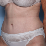 Tummy Tuck Before & After Patient #34668