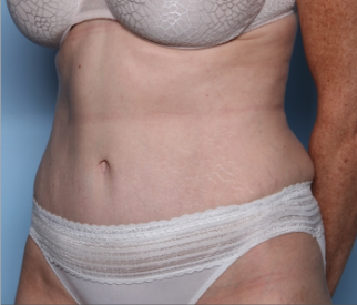 Tummy Tuck Before & After Patient #34668