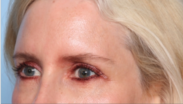 Blepharoplasty Before & After Patient #34649