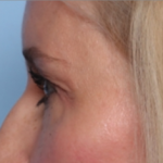 Blepharoplasty Before & After Patient #34649