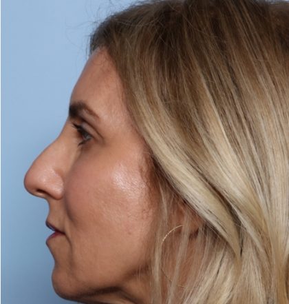 Injectable Fillers Before & After Patient #34707