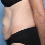 Tummy Tuck Before & After Patient #34668