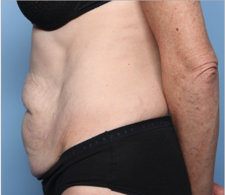 Tummy Tuck Before & After Patient #34668