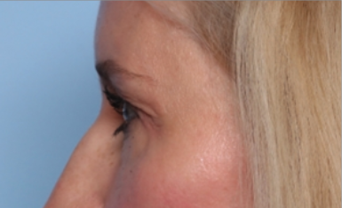 Blepharoplasty Before & After Patient #34649