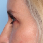 Blepharoplasty Before & After Patient #34649